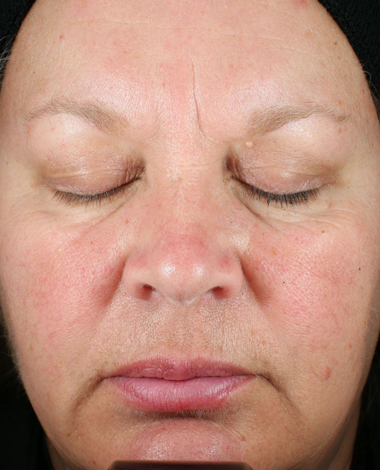 Bio Serum Firm Before