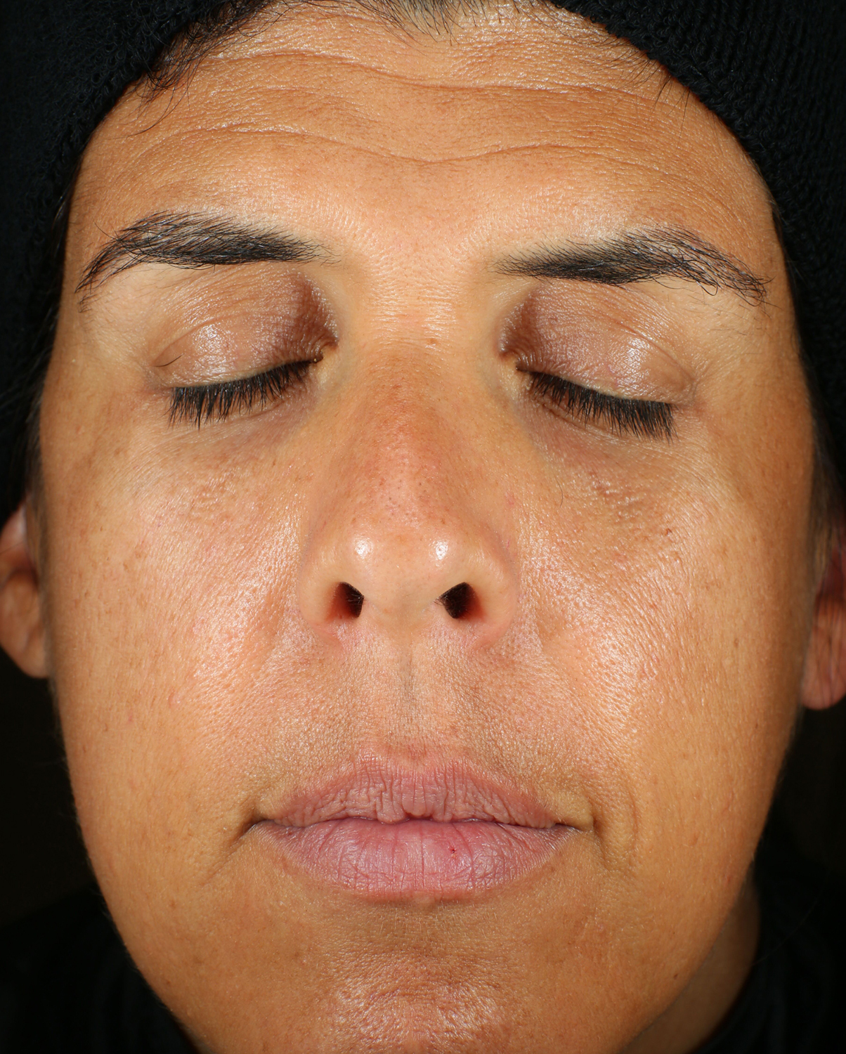 Bio Cream Serum Before