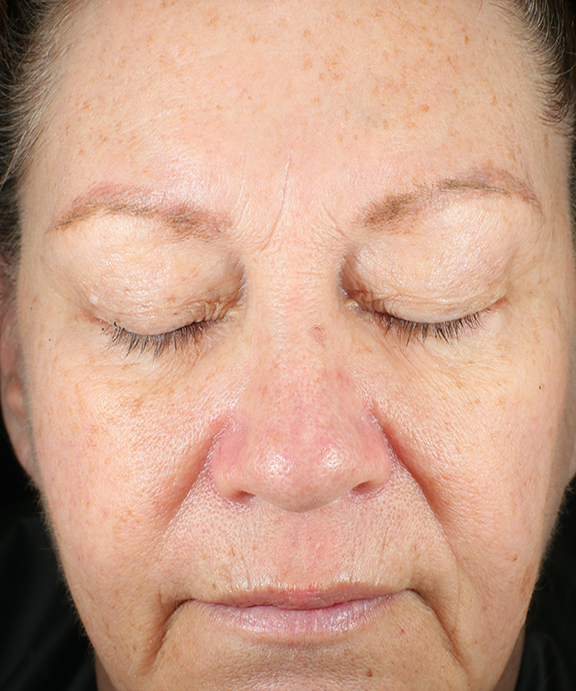 Bio Gel Firm Before